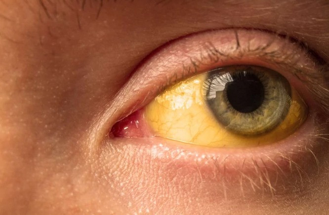 Người bị viêm gan A có thể vàng da hoặc mắt (Ảnh: Internet)