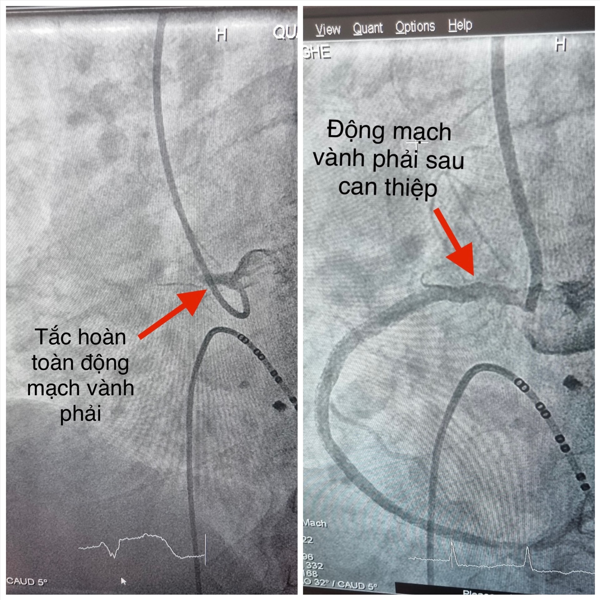 Ảnh chụp trên hệ thống DSA trước và sau khi bác sĩ can thiệp đặt stent mạch vành cho bệnh nhân. Ảnh: BVCC