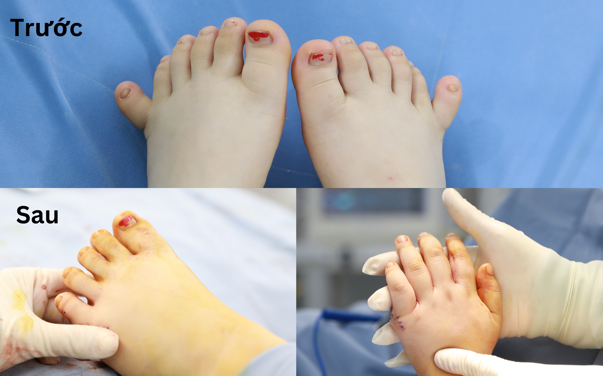 Hình ảnh bàn tay, chân của em T.L trước và sau phẫu thuật