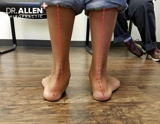 Triệu chứng của hội chứng bàn chân bẹt