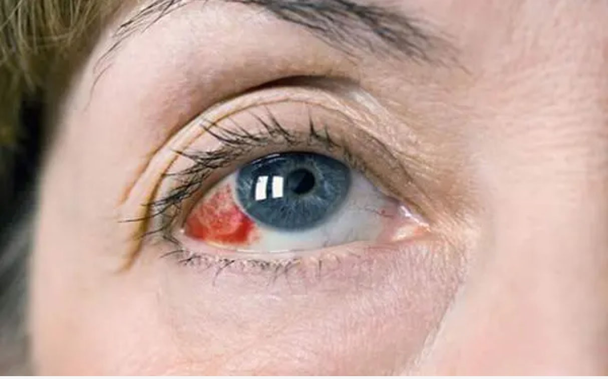 Đột quỵ mắt xảy ra khi các tĩnh mạch hoặc động mạch của võng mạc bị tắc nghẽn do cục máu đông hoặc mạch máu bị thu hẹp dẫn tới mất thị lực đột ngột (Ảnh: Internet)