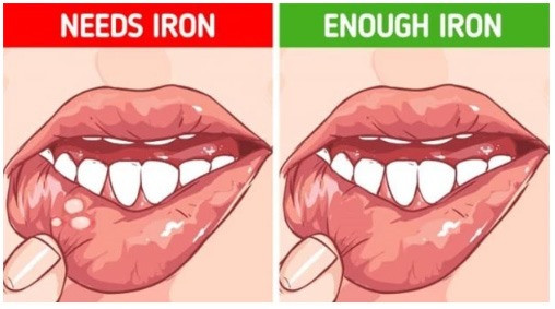 Những lý do gây lở loét miệng phổ biến nhất là hút thuốc, dị ứng, vô tình cắn vào lưỡi hay bị viêm.