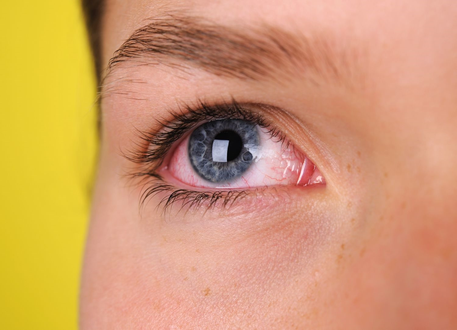 Đau mắt đỏ cần được điều trị đúng cách để tránh biến chứng có thể xảy ra.