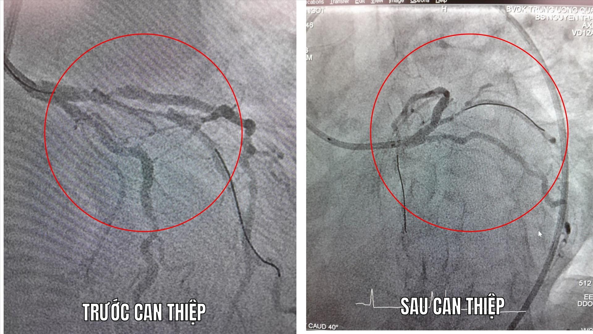 Hình ảnh mạch máu tim trước và sau can thiệp đặt 1 stent vào đoạn hẹp động mạch liên thất trước. Ảnh: BÙI HUÂN