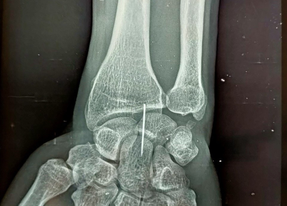 Kim khâu trong cổ tay của bệnh nhân qua hình ảnh X.quang. Ảnh: T.D