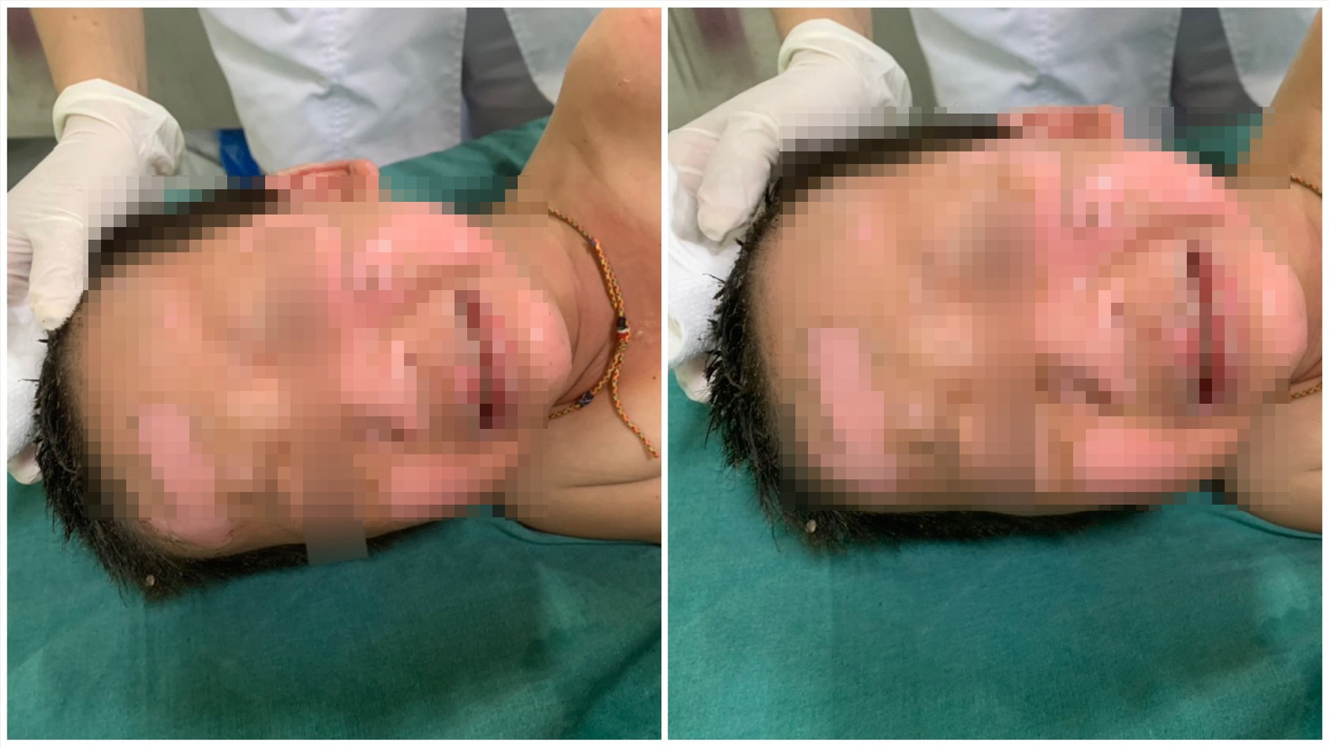 Bệnh nhi T.T.S. (4 tuổi, xã Ninh Phước, huyện Nông Sơn) bị bỏng vùng đầu, mặt và cổ ngay khi nhập viện. Ảnh: QUẢNG CHƯƠNG