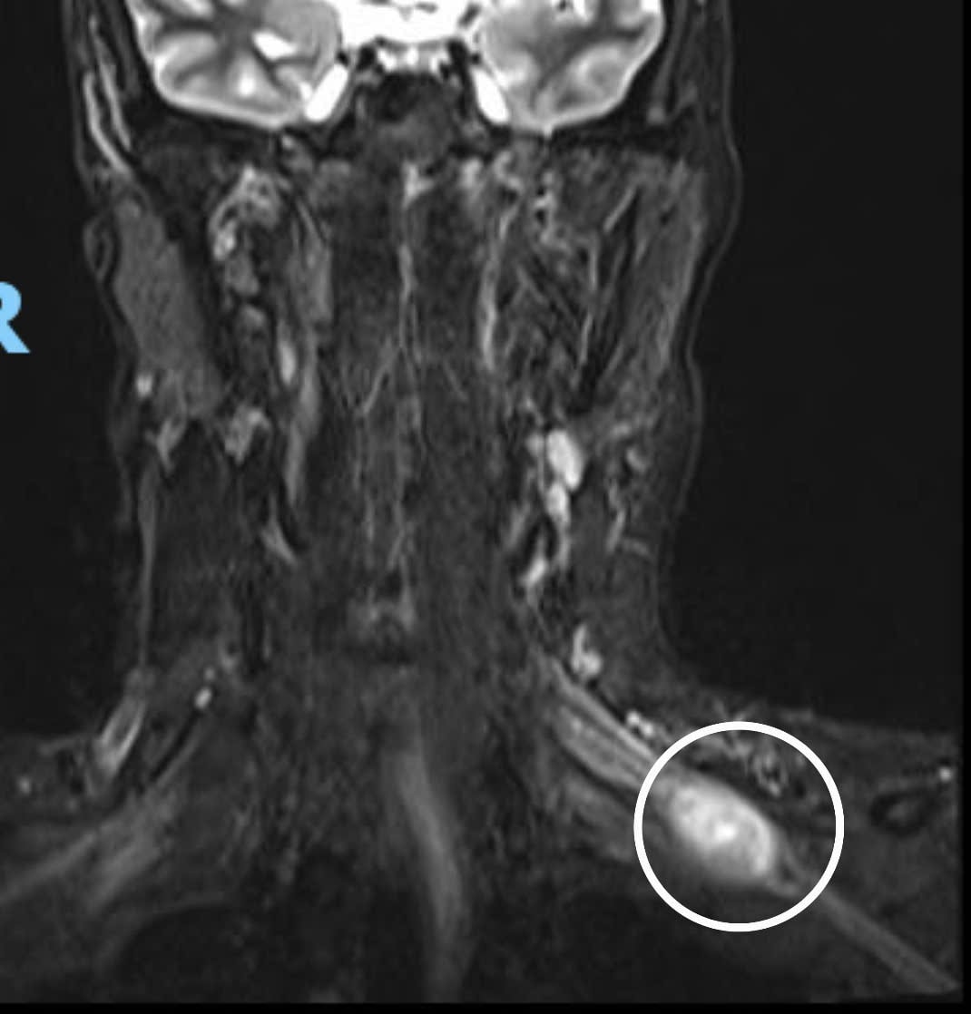 МРТ-зображення пухлини