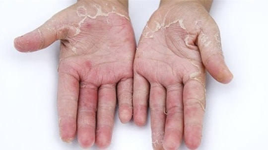 Dấu hiệu cảnh báo cơ thể đang thiếu vitamin C