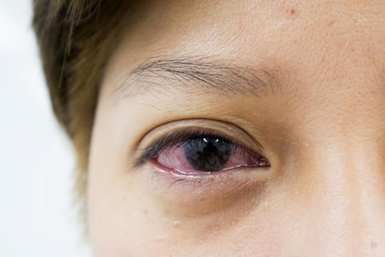 Con có triệu chứng mắt đỏ tưởng bình thường, ai ngờ mắc bệnh hiểm