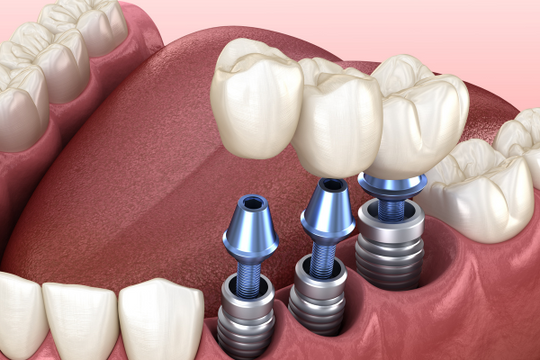 Trồng răng Implant - Giải pháp vượt trội phục hình răng đã mất