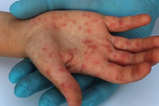 Biến chứng thường gặp của bệnh tay chân miệng