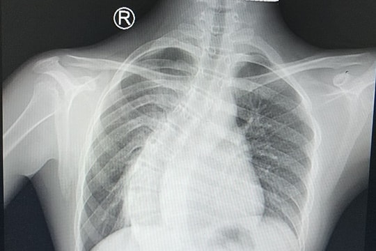 Phẫu thuật thành công bệnh nhi 14 tuổi bị gù vẹo cột sống nặng