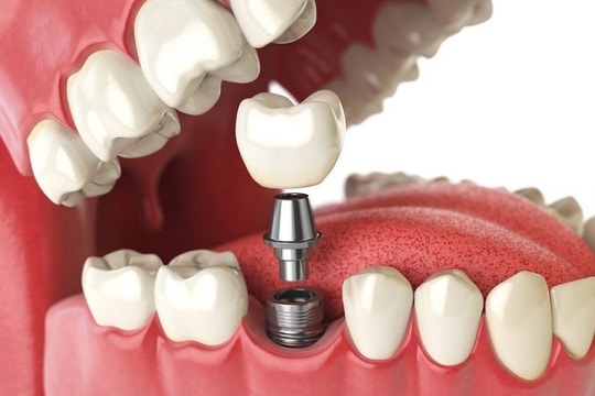 Trồng răng Implant - Giải pháp cải thiện tình trạng mất răng hiệu quả