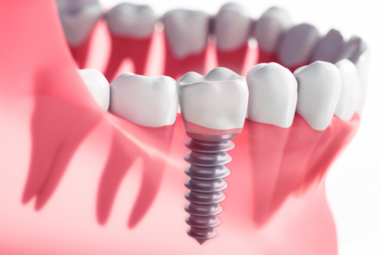 Bảng giá trồng răng Implant trên thị trường hiện nay