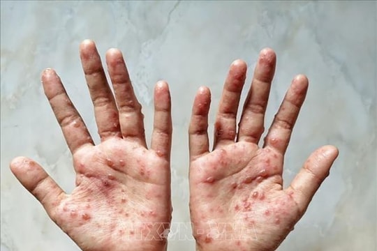 WHO duy trì cảnh báo cao nhất về đậu mùa khỉ