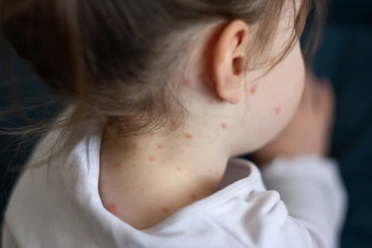 Dịch bệnh sởi trở lại châu Âu