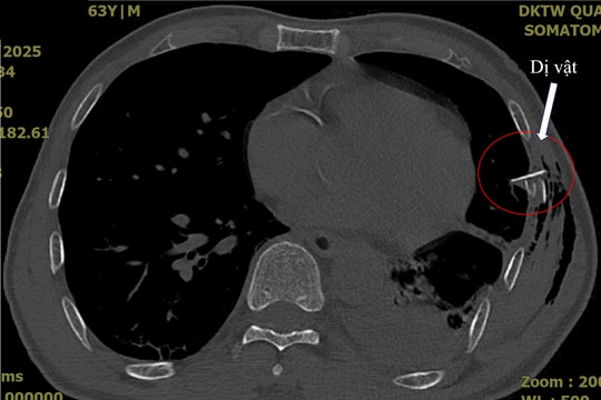 Cứu sống bệnh nhân bị chấn thương thủng phổi do mảnh gãy của xương sườn