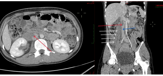 Bệnh viện Đa khoa Quảng Nam điều trị thành công một trường hợp mắc bệnh hiếm gặp