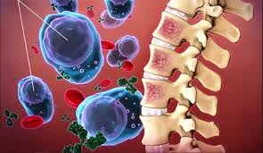 Thêm cơ hội cho người bệnh đa u tủy xương