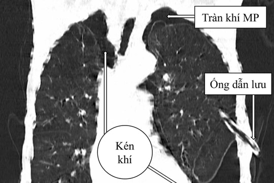 Bệnh viện Đa khoa Trung ương Quảng Nam điều trị thành công ca tràn khí màng phổi phức tạp