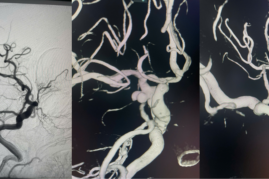 Bệnh viện Đa khoa Quảng Nam can thiệp thành công ca xuất huyết dưới nhện do vỡ túi phình động mạch não phức tạp