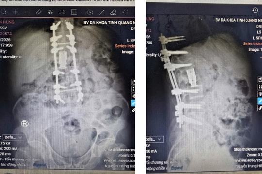 Phẫu thuật hai lối cứu bệnh nhân gãy cột sống phức tạp