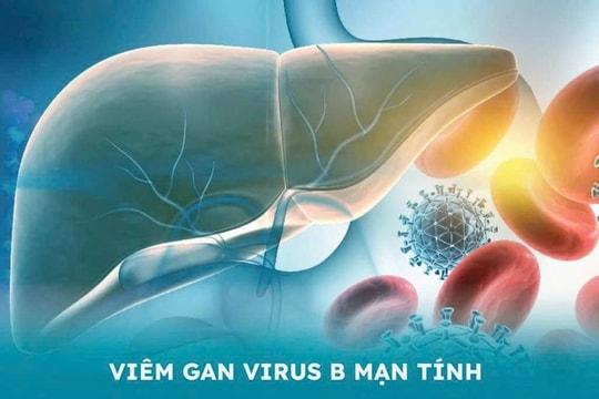 Sống khỏe cùng viêm gan B mạn tính